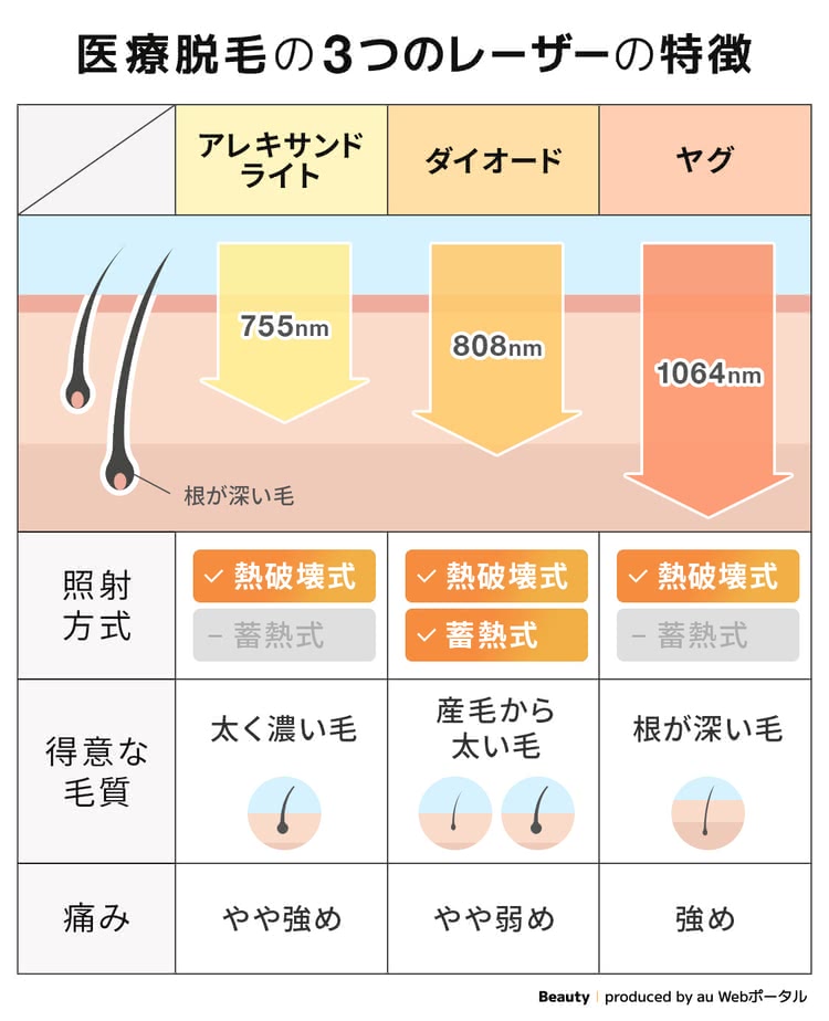 医療脱毛の3つのレーザーの特徴