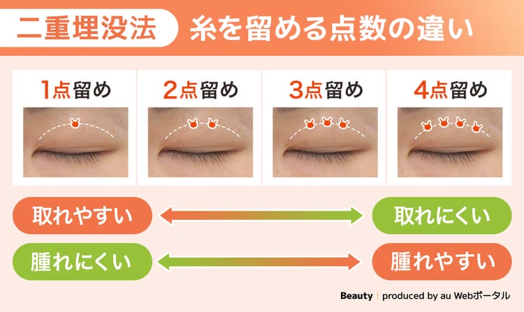 二重整形の埋没法の糸を留める点数の違い