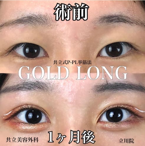 共立美容外科の二重整形の症例写真