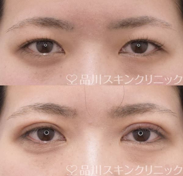 品川美容外科の二重整形の症例写真