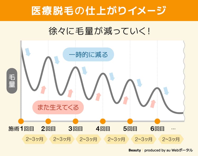 脱毛の仕上がりイメージ