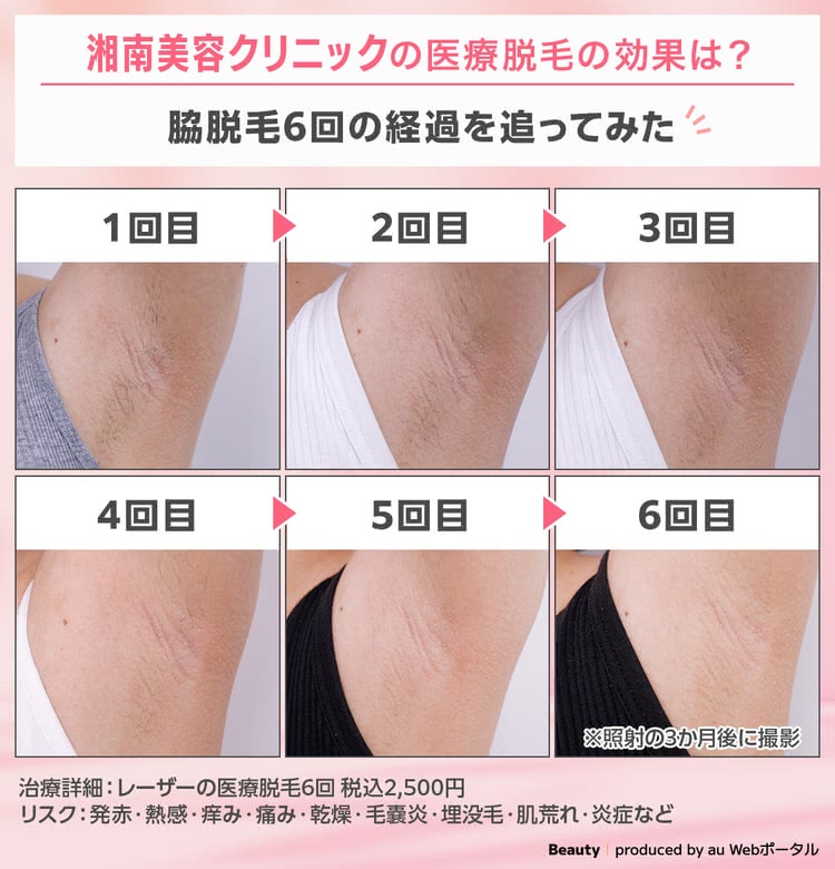 脇の医療脱毛を5回受けたBEAUTY編集部員