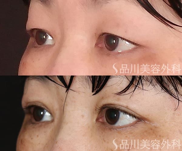 品川美容外科の二重整形の症例写真